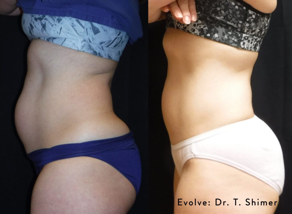 EvolveX body contouring Mount Prospect IL, non-invasive body contouring, radiofrequency skin tightening, EMS muscle stimulation, fat reduction treatment, build muscle without surgery, skin tightening treatment near me, body sculpting abdomen arms thighs, non-surgical fat reduction Chicago suburbs, no downtime body contouring, RF body tightening Mount Prospect, muscle toning treatment near me
